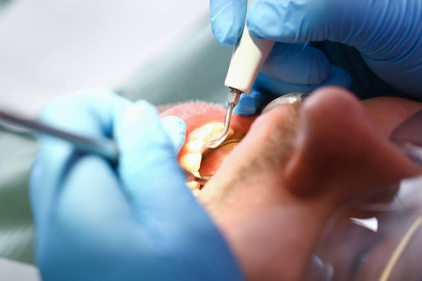 Best Chipped Tooth Repair Near Me  in Memphis, MO